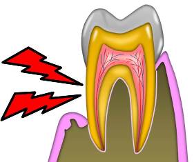 歯の神経.jpg
